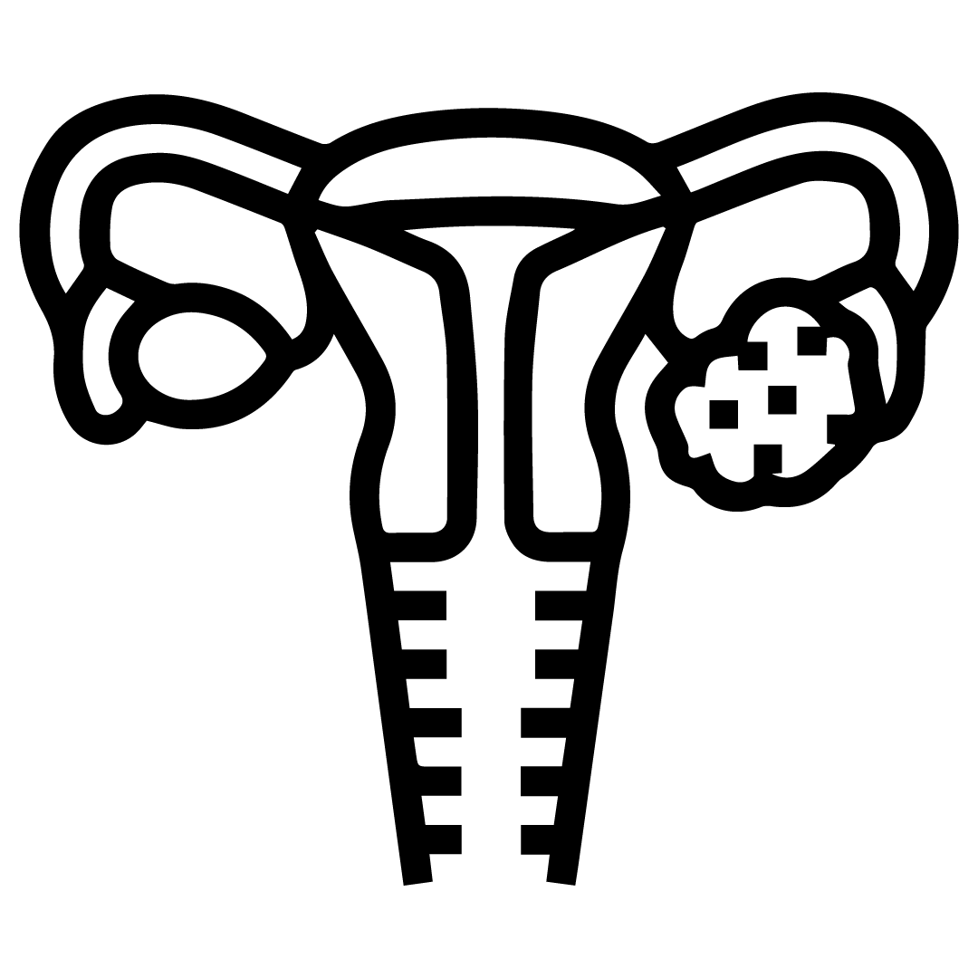 PCOD Treatment
