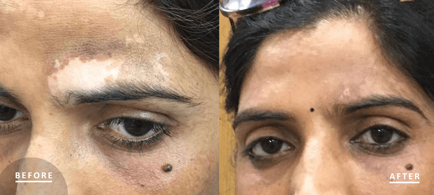 http://Vitiligo