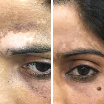 Vitiligo