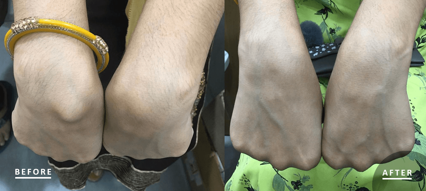 http://Ganglion%20or%20Nodules%20or%20Lipomas